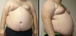 Metabolic Syndrome patient